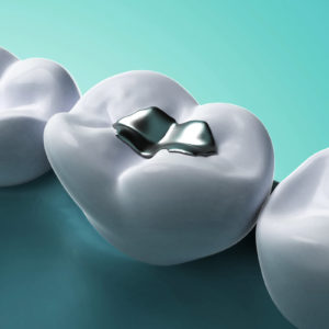 Amalgam-Abfälle sind aufgrund des Quecksilberanteils als gefährlicher Abfall zu entsorgen. (Foto: Sebastian Kaulitzki, Fotolia)