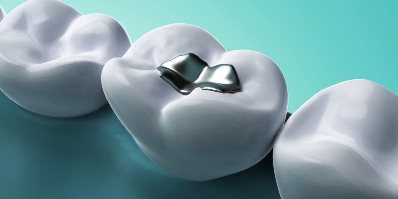 Amalgam-Abfälle sind aufgrund des Quecksilberanteils als gefährlicher Abfall zu entsorgen. (Foto: Sebastian Kaulitzki, Fotolia)