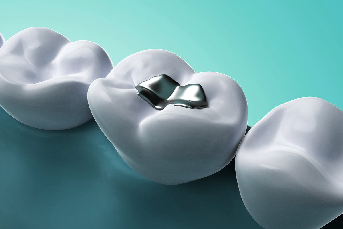Amalgam-Abfälle sind aufgrund des Quecksilberanteils als gefährlicher Abfall zu entsorgen. (Foto: Sebastian Kaulitzki, Fotolia)