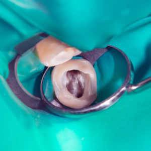 Amalgam aus der Zahnmedizin gehört zu den gefährlichen Abfällen (Foto: Сергей-Кучугурный, AdobeStock)