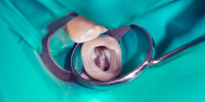 Amalgam aus der Zahnmedizin gehört zu den gefährlichen Abfällen (Foto: Сергей-Кучугурный, AdobeStock)